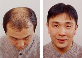 Nido - Exoderm Hair implant