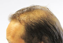 Exoderm artificial Hair Implant