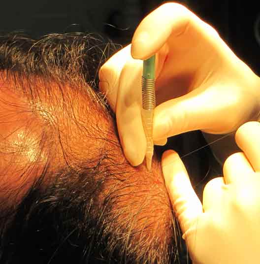 exoderm hair implant